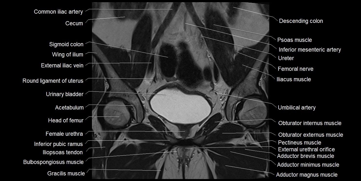 female pelvis coronal cross sectional anatomy image 14.webp